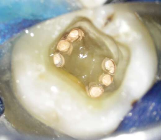Zahn-OP Endodontie